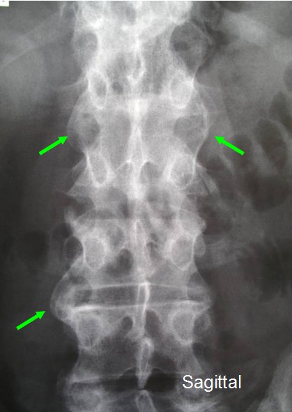 Back Pain and Enthesopathy in Psoriasis and early Psoriatic Arthritis